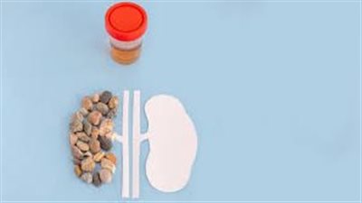 مذيب حصوات الكلى.. 8 مذيبات طبيعية وأفضل فوار لتفتيت الحصى