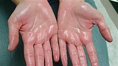 أسباب تعرق اليدين المفرط.. تخلى عن توترك وانعم بالهدوء