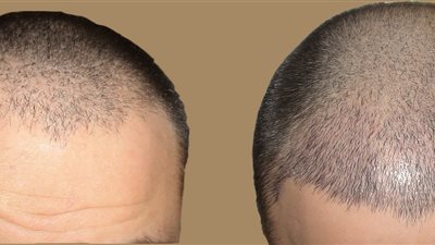 زراعة الشعر.. هل هي عملية مضرة؟ 