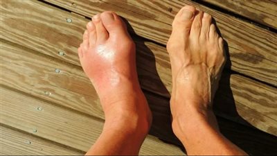 أسباب وأعراض مرض النقرس.. وخيارات العلاج والوقاية