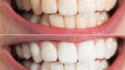 طريقة فعالة وآمنة.. ما هي خطوات تبييض الأسنان؟