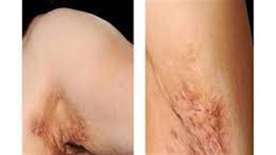 علاج التهاب الغدد العرقية القيحي.. يساعد التبكير في السيطرة على الألم