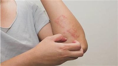 أسباب الحكة الجلدية.. 9 عوامل تسبب الحساسية بعضها خطير جدًا 