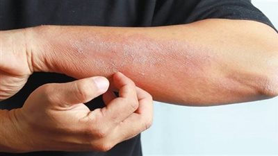 كيف تكون حكة السرطان؟.. يصاحبها 6 علامات أساسية