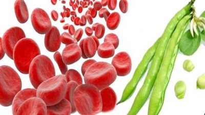 أسباب أنيميا الفول.. والاعراض وطرق العلاج 