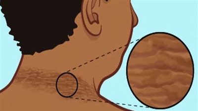 كيف يتم تشخيص مقاومة الإنسولين؟ 