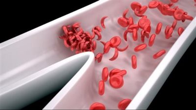 منها فقر الدم المنجلي.. ما هي اضطرابات الدم النادرة وأنواعها وعلاجها؟