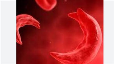  أبرز أعراض فقر الدم المنجلي.. وطرق الوقاية منه وأسباب الإصابة به