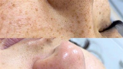  كيفية تنظيف البشرة بعمق قبل وبعد العملية