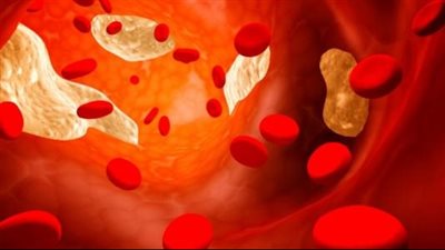 أعراض ارتفاع الدهون الثلاثية.. الضغط المرتفع جرس انذار