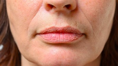 أسباب التجاعيد الأنفية الشفوية.. منها زيادة التوتر النفسي