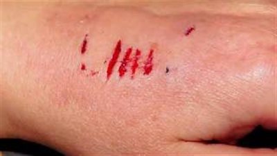 هل خربشة قطط الشارع خطر؟.. تعرف متى يؤخذ مصل السعار 