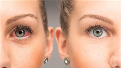 ما الفرق بين التهاب العين وحساسية العين؟ اعرف الاختلاف بينهما في الربيع