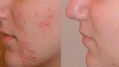 وصفات منزلية.. خطوات علاج حب الشباب بسهولة.. منها قناع العسل والقرفة