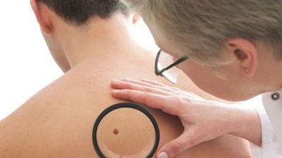 علاج سرطان الجلد.. ثورة في مجال الطب