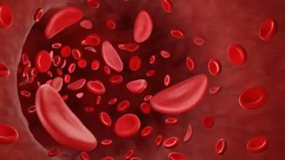 أعراض أنيميا البحر الأبيض المتوسط وطرق علاجها.. أعرف السبب.. فيديو يكشف حقائق