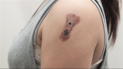 skin cancer.. سرطان الجلد: الأسباب، والأعراض، وطرق العلاج.. تقارير طبية تفجر مفاجأة