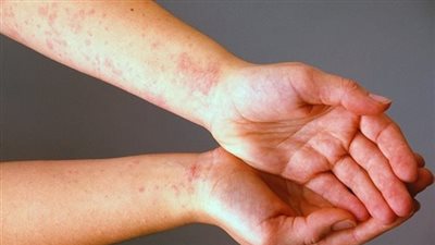ما هى أعراض حساسية الفسيخ؟.. احذر تجاهلها واطلب الطوارئ فورا