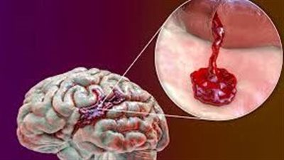 ما مضاعفات نزيف المخ؟.. الغيبوبة واحتمالات الوفاة