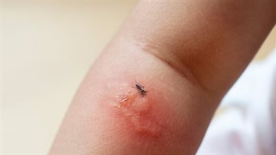 أعراض حساسية لدغ الناموس.. احترس من انتفاخ العقد الليمفاوية