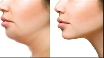 أسباب ترهل الألغاد.. الشيخوخة وفقدان الوزن أبرزها