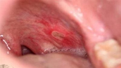 أفضل نظام غذائي لمرضى القولون التقرحي 