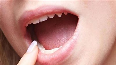متى يكون لون اللسان خطير؟.. اعرف صحتك من لون لسانك