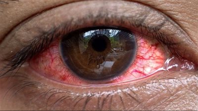 سبب جفاف العين.. ما تاثير العدسات اللاصقة؟