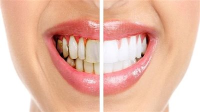 علاج تسوس الأسنان في المنزل بـ 5 خطوات وقائية