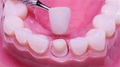 فوائد تركيب طربوش الأسنان 