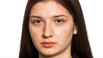 علاج بثور الوجه في المنزل بـ 6 خطوات طبيعية ودوائية
