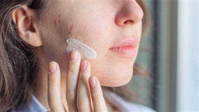 علاج حب الشباب للبشرة الدهنية.. 7 توصيات طبية مهمة