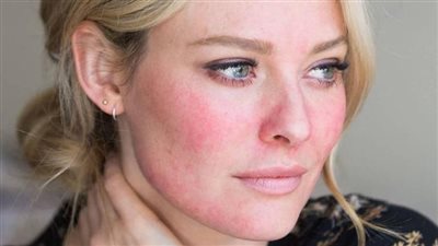 العناية بالبشرة الحساسة في فصل الصيف.. 4 نصائح ذهبية لكل أنثى