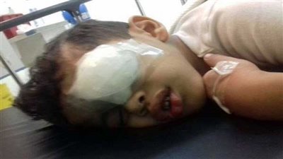 أضرار الألعاب النارية فى العيد.. مخاطر العمى والبتر 