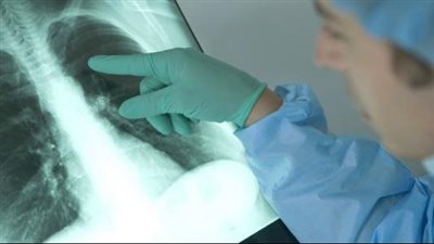 أعراض سرطان الرئة عند الرجال.. 7 علامات أبرزها السعال المستمر