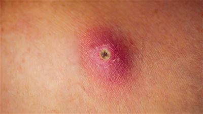 أسباب الدمامل عند الأطفال فى الصيف 