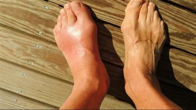 كيفية الوقاية من النقرس.. وزارة الصحة توضح 