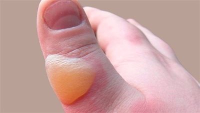 درجات حروق الزيت المغلي وطرق العلاج.. احترسي فى مطبخك