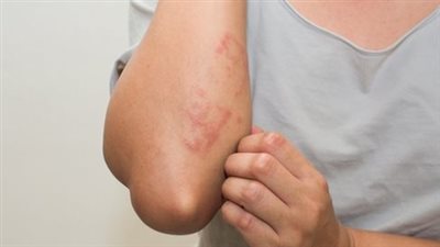 علاج حساسية الجلد في المنزل بـ 7 طرق مجربة 