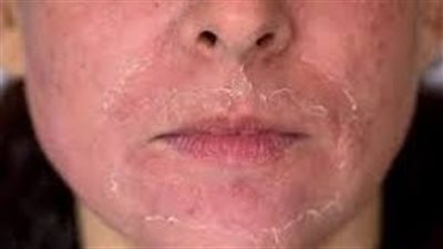 ما أضرار التقشير الكيماوى للبشرة؟