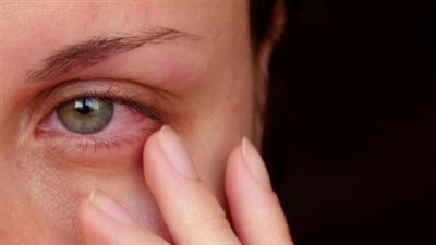 علاج التهاب العين في المنزل بـ 4 طرق بسيطة.. احذر هذه الأعراض