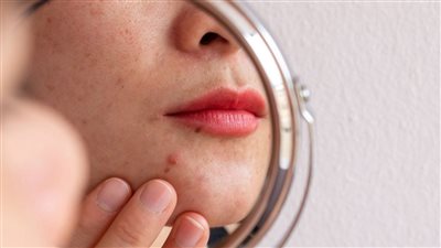 علاج حب الشباب الهرموني للنساء وعلاقته بالدورة الشهرية