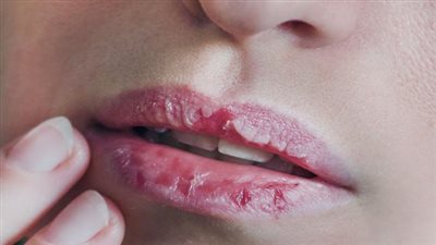 علاج تشقق الشفاه في المنزل بـ 4 مكونات فقط