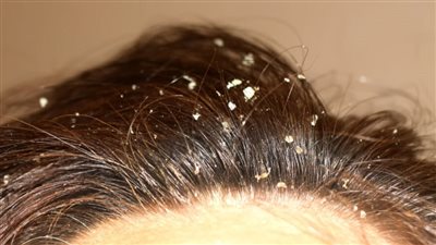 علاج قشرة الشعر في المنزل بـ 5 خطوات مهمة جدا