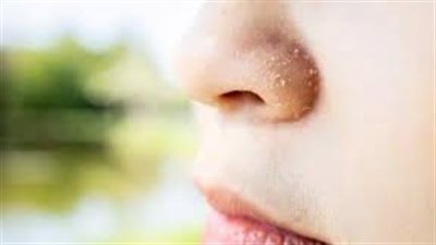 أسباب جفاف الجلد حول الأنف