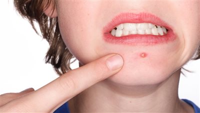 لماذا تظهر الخراريج عند الأطفال في الصيف؟ 