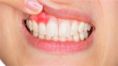علاج التهاب اللثة سريع المفعول.. 6 علاجات منزلية فعالة لتقليل التورم