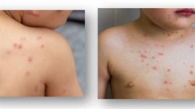 علاج جدري الماء عند الأطفال بالخل وملح البحر للتخلص من الحكة