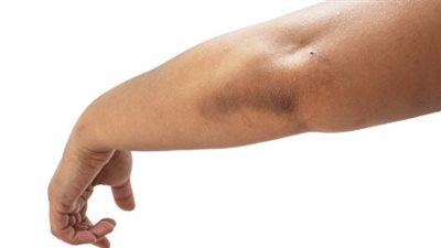 ما هي الأسباب الشائعة وراء الشواك الأسود؟