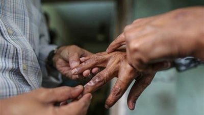 تسجيل أكثر من 140 حالة إصابة بالجذام في منطقة موبا بالكونغو الديمقراطية